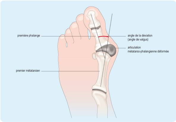 Description hallux valgus