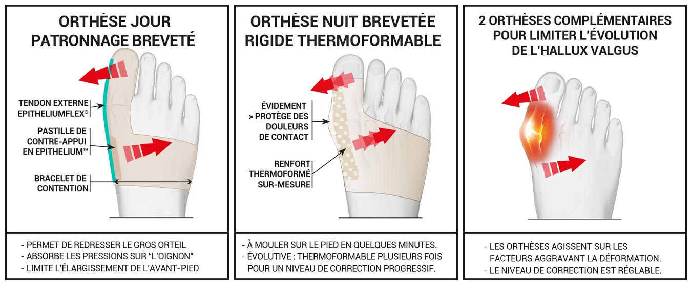 Correction hallux valgus avec orthèses jour et nuit